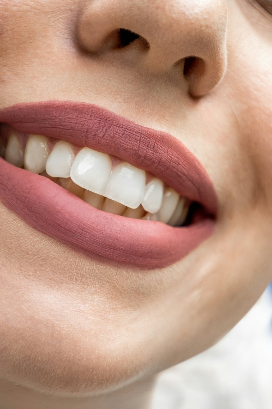 Teeth whitening after (sample)