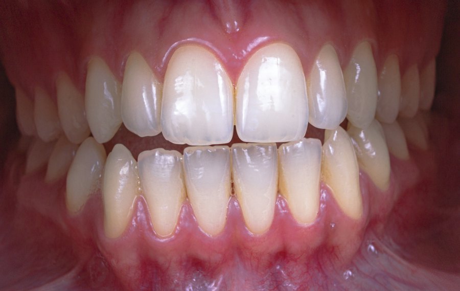 Teeth whitening before (sample)