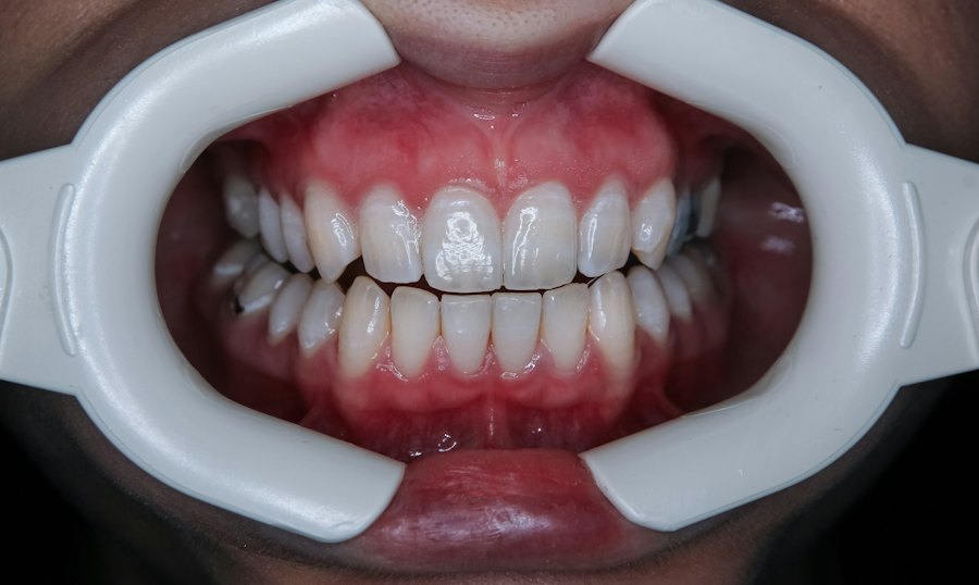 Smile correction after (sample)