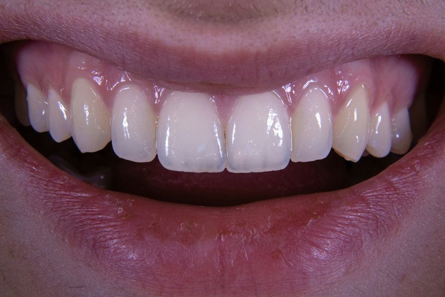 Teeth cleaning after (sample)