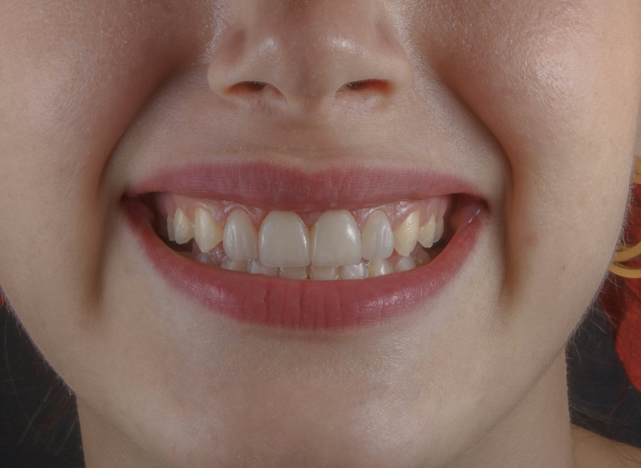 Teeth cleaning before (sample)